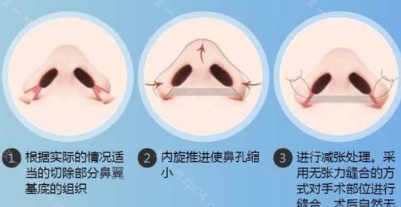 全面解析隆鼻费用，从因素到价格