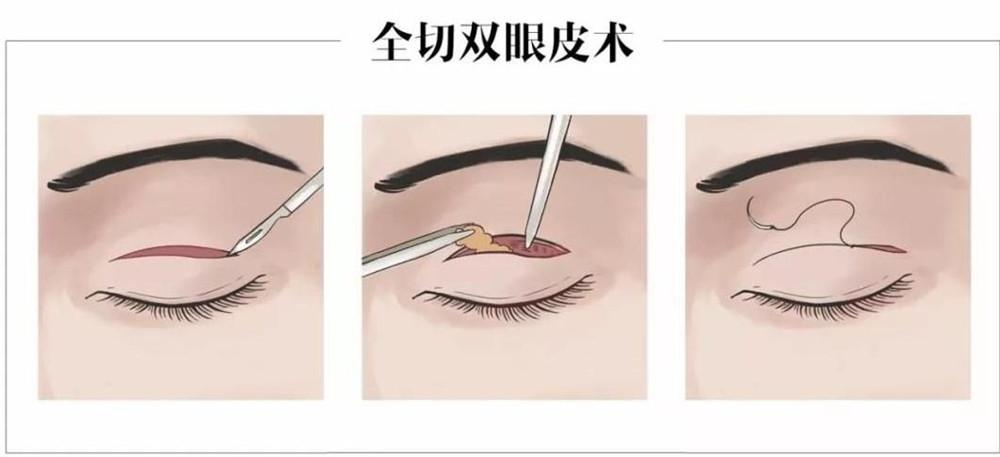 全切双眼皮费用详解，价格因素与选择考量