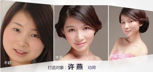 医院打瘦脸针，美丽新选择