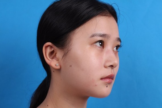 耳软骨隆鼻，重塑美丽，自信闪耀