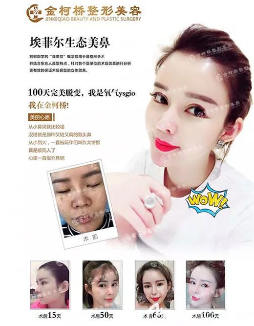 关于隆鼻价格多少的全面解析