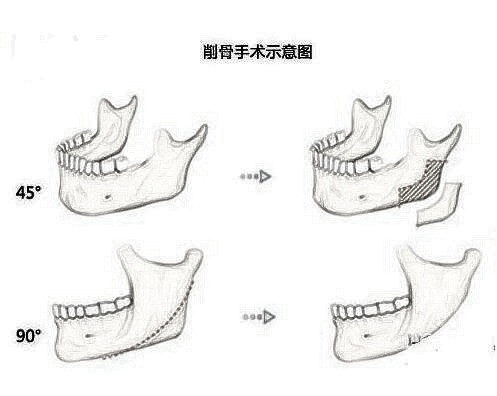 磨骨瘦脸手术费用详解，多少钱才能实现美丽梦想？