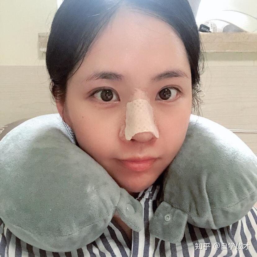 自体软骨隆鼻后遗症解析