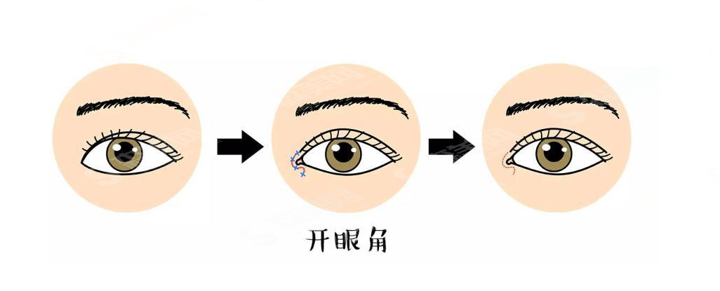 开眼角手术价格及其相关因素探讨