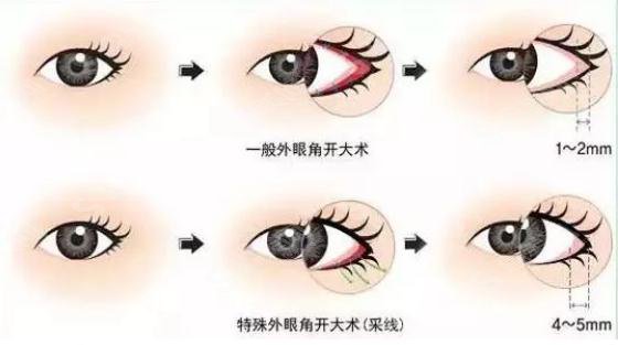 开眼角手术价格详解，因素、费用及注意事项