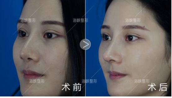 鼻尖整形对比图，重塑美丽，自信闪耀