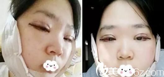 下巴整形费用全面解析，多少钱才能实现美丽梦想？