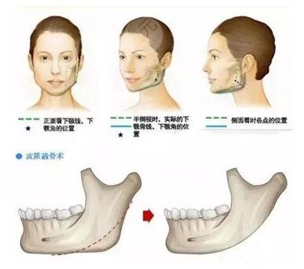 下颌角截骨手术，重塑面部轮廓的艺术与科学