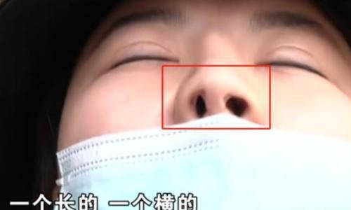 关于歪鼻整形的费用分析