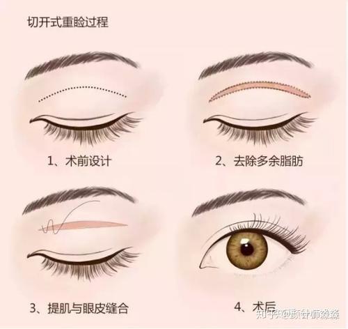 韩式埋线双眼皮的价格解析