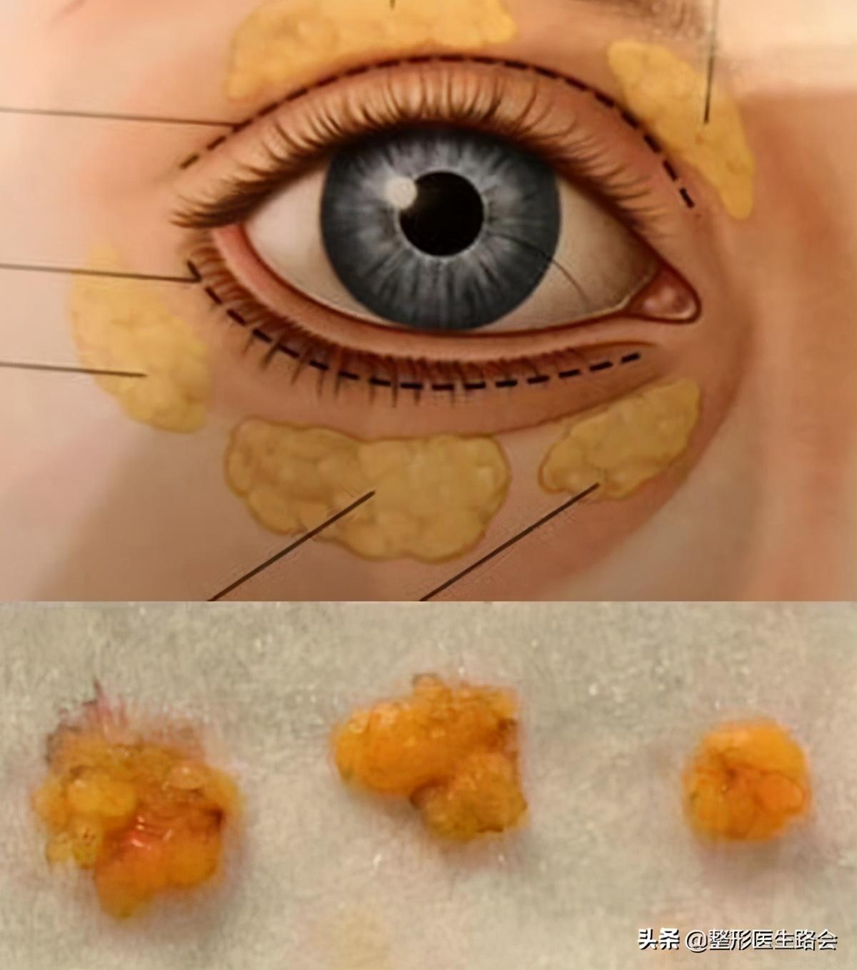 去除眼袋手术，重塑眼部魅力的秘密武器