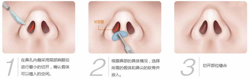隆鼻假体，塑造完美鼻型的秘密武器