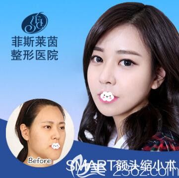 面部整形的费用及其相关因素解析