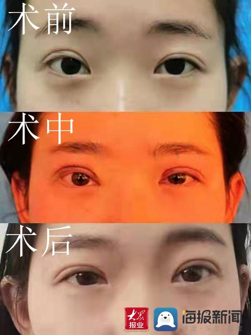 双眼皮修复手术，重塑美丽双眼的艺术