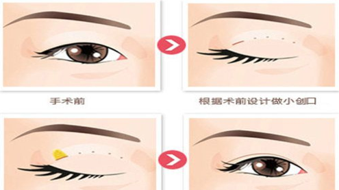 小腿吸脂手术费用详解，多少钱让你拥有完美腿部线条？