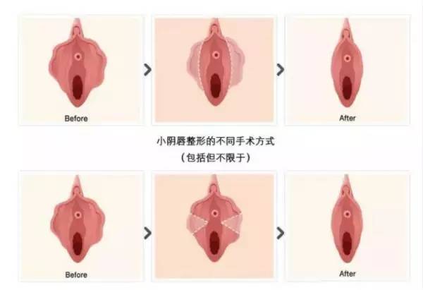 阴唇肥大整形的探索与理解
