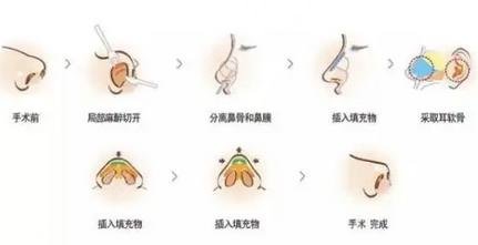 鼻梁整形的费用分析