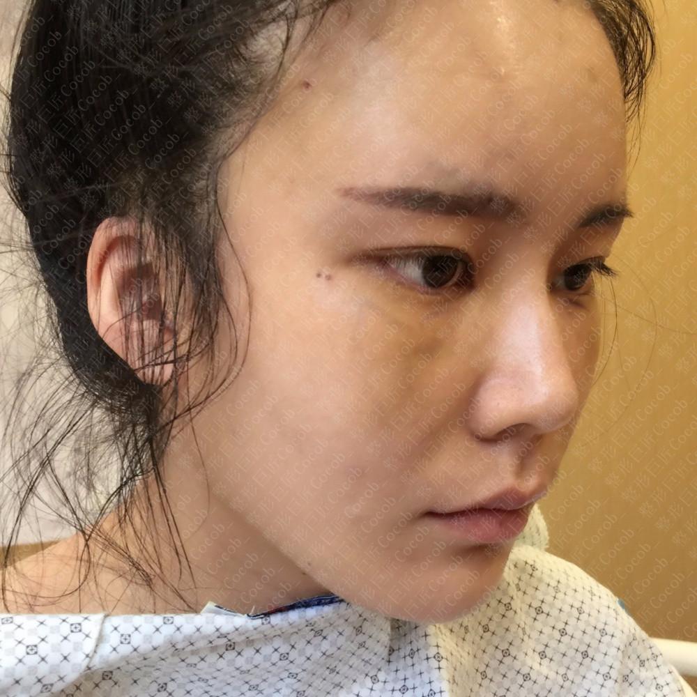 自体脂肪填充泪沟，重塑面部魅力的创新技术