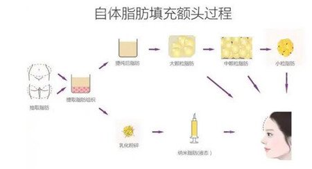 自体脂肪面部填充价格，全面解析费用因素与选择策略