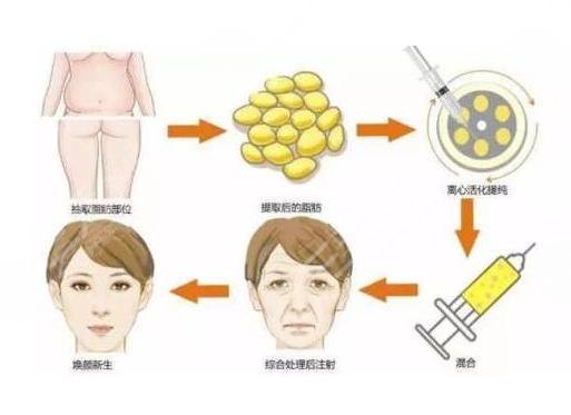 自体脂肪填充面部价格，全面解析与了解
