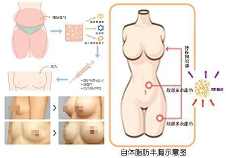 自身脂肪隆胸手术，探索与理解