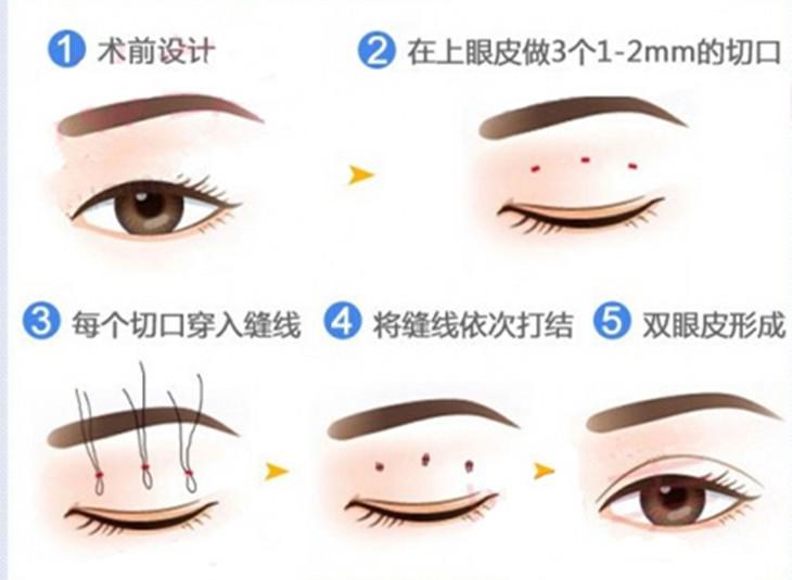 双眼皮开眼角手术的价格因素与深度解析