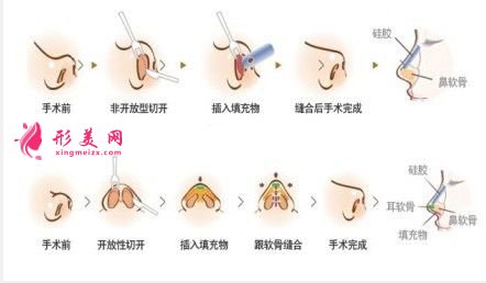 鼻部整形术费用全面解析