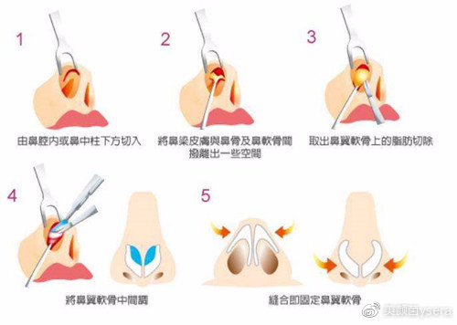 鼻头缩小手术费用详解，多少钱才能实现美丽转变？