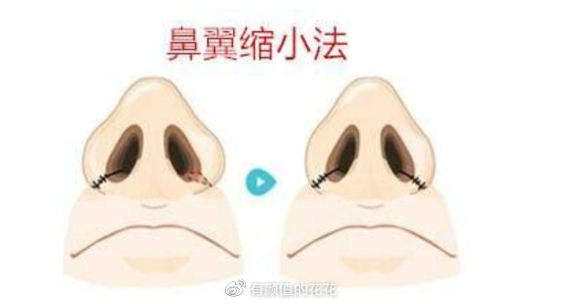 鼻翼缩小手术价格详解，因素、费用及注意事项