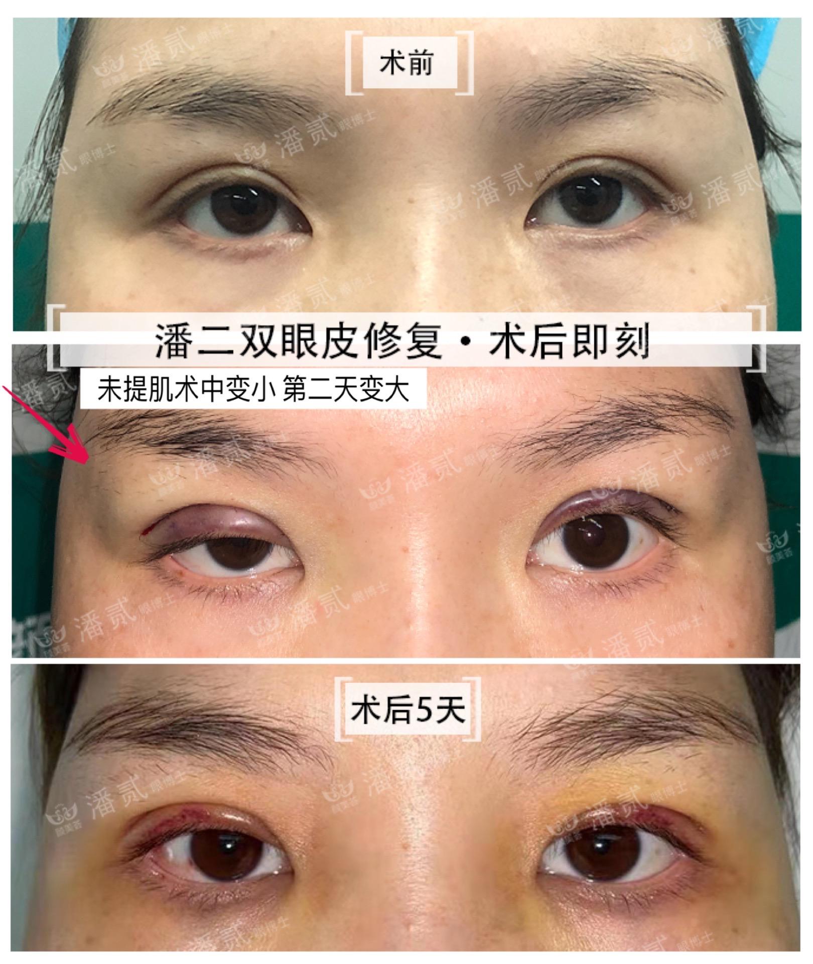 韩式压双眼皮的价格及其相关因素探讨
