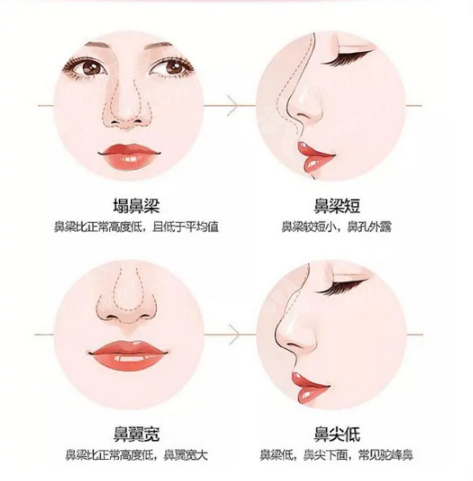 膨体假体隆鼻，重塑完美鼻型的理想选择