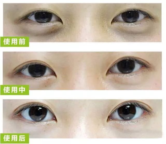 开眼角手术，重塑眼部魅力的秘密武器