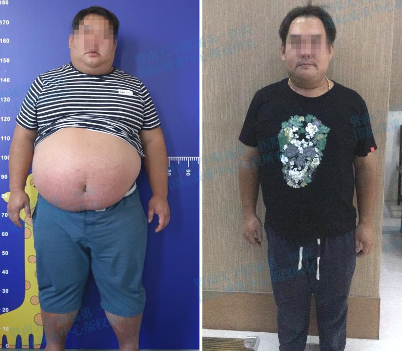 腹部吸脂减肥价格，了解与选择