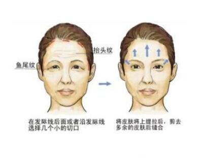 面部除皱费用详解，价格因素与选择考量