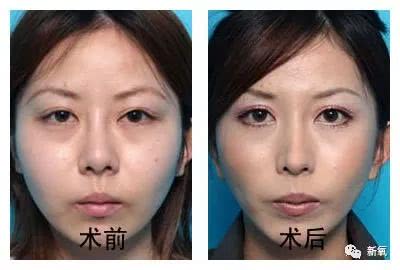 面部吸脂会反弹吗？全面解析吸脂手术与保养的重要性