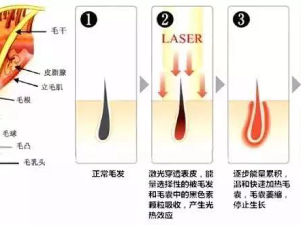 走进医院脱毛，现代脱毛技术的专业解读