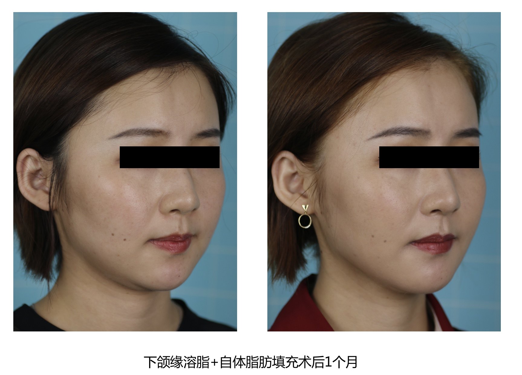 面颊吸脂，重塑美丽轮廓的秘诀