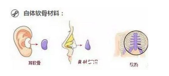 软骨隆鼻手术费用详解，多少钱？