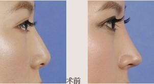 软骨隆鼻手术费用详解，价格因素与个性化选择