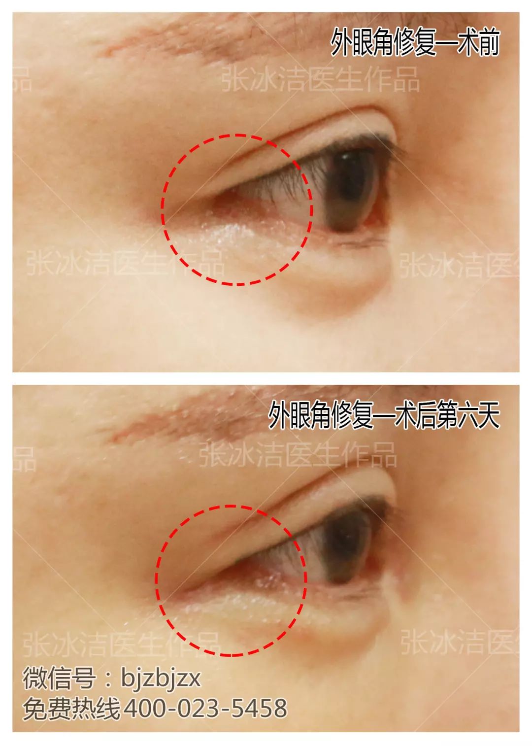 眼睛整形的探索与实践