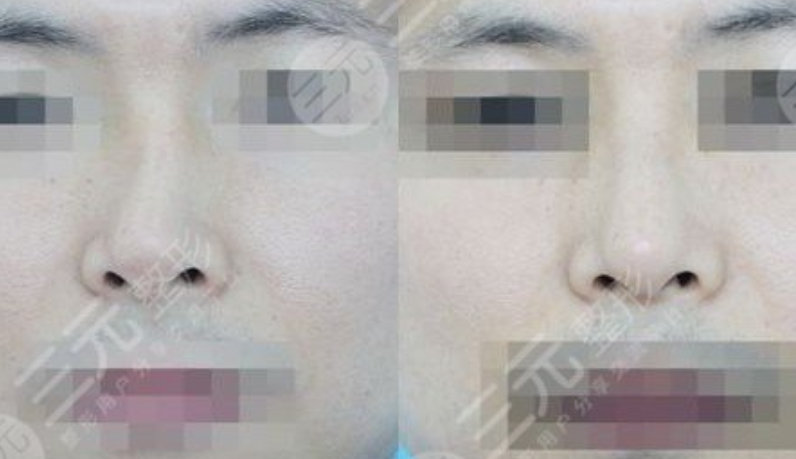 关于歪鼻整形的费用解析