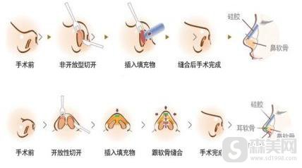 鼻翼缩小手术价格详解，因素、费用及注意事项