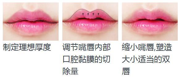 注射丰唇，重塑唇部魅力，展现自信微笑