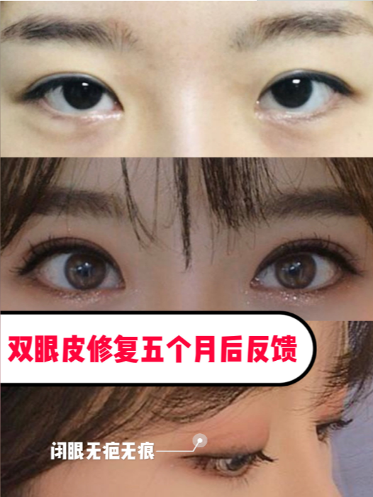 双眼皮的魅力，开双眼皮手术的选择与体验