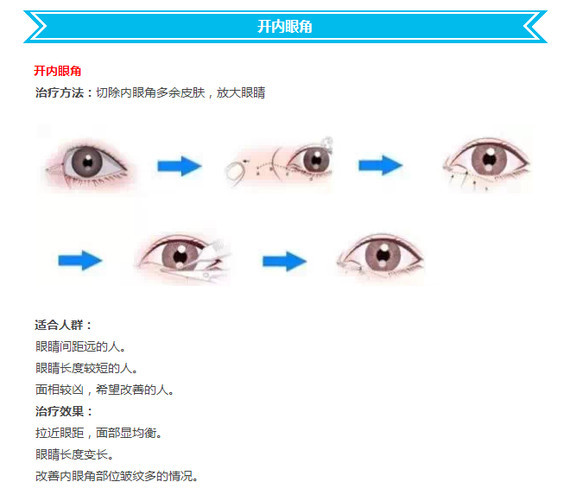开眼角手术过程详解