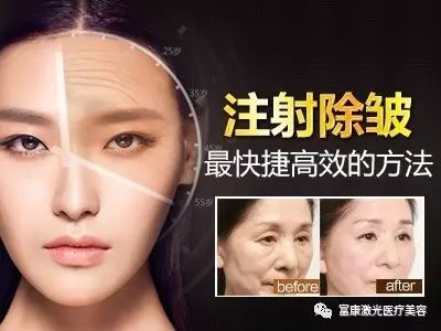 眼角除皱术，重塑青春魅力的秘密武器