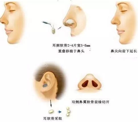 自体软骨隆鼻整形手术，重塑鼻部轮廓的艺术