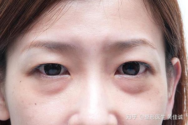 眼部整容价格，深度解析与指导