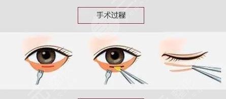 手术去眼袋要多少钱，全面解析费用因素与选择策略