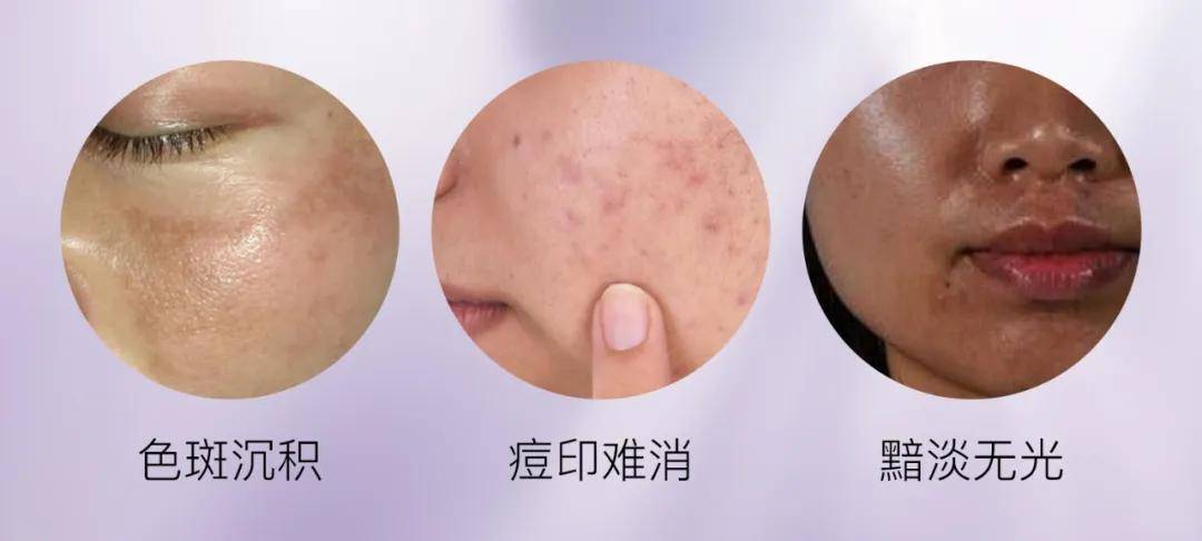 百莲凯祛斑效果深度解析